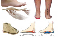 Ортопедичне взуття – комфортне пересуван…